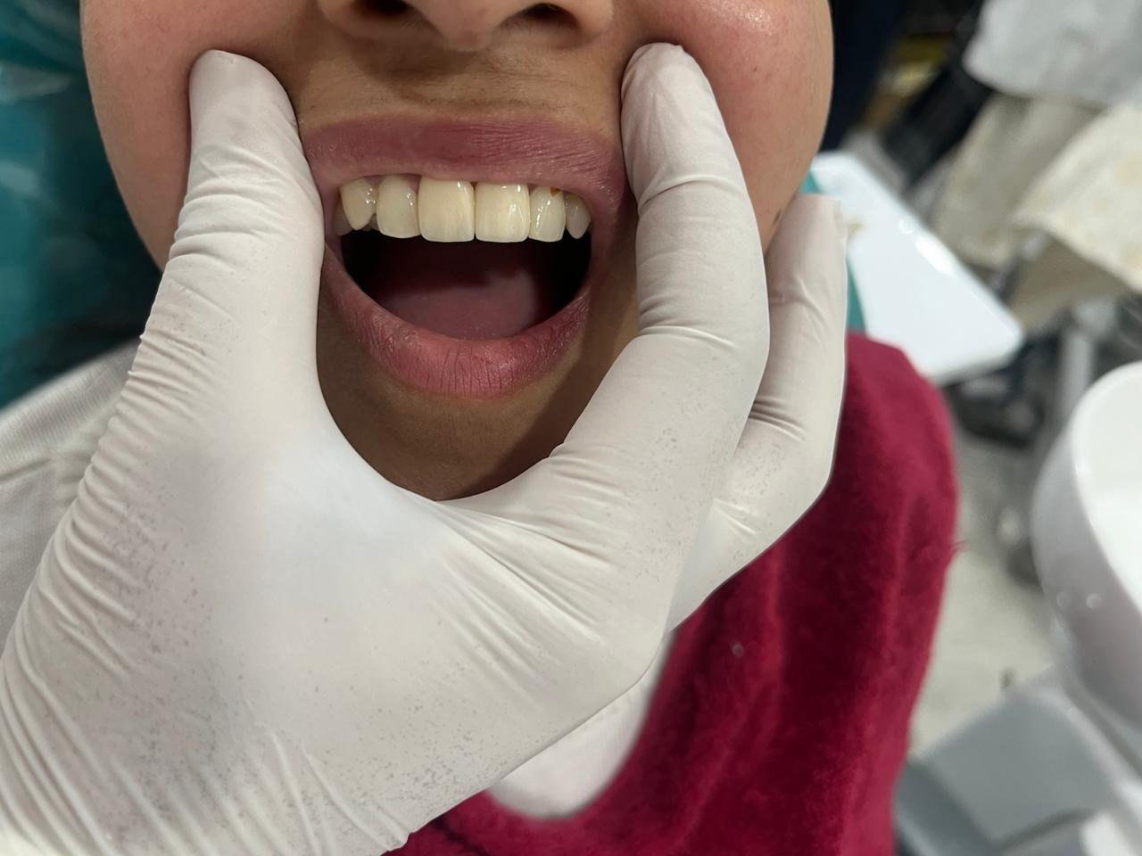 Dental Implant After - Central Polyclinic